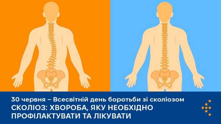 Сколіоз: хвороба, яку необхідно профілактувати та лікувати